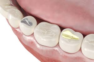Dental Filling: The Solution to Cavity Treatment in Pennsylvania