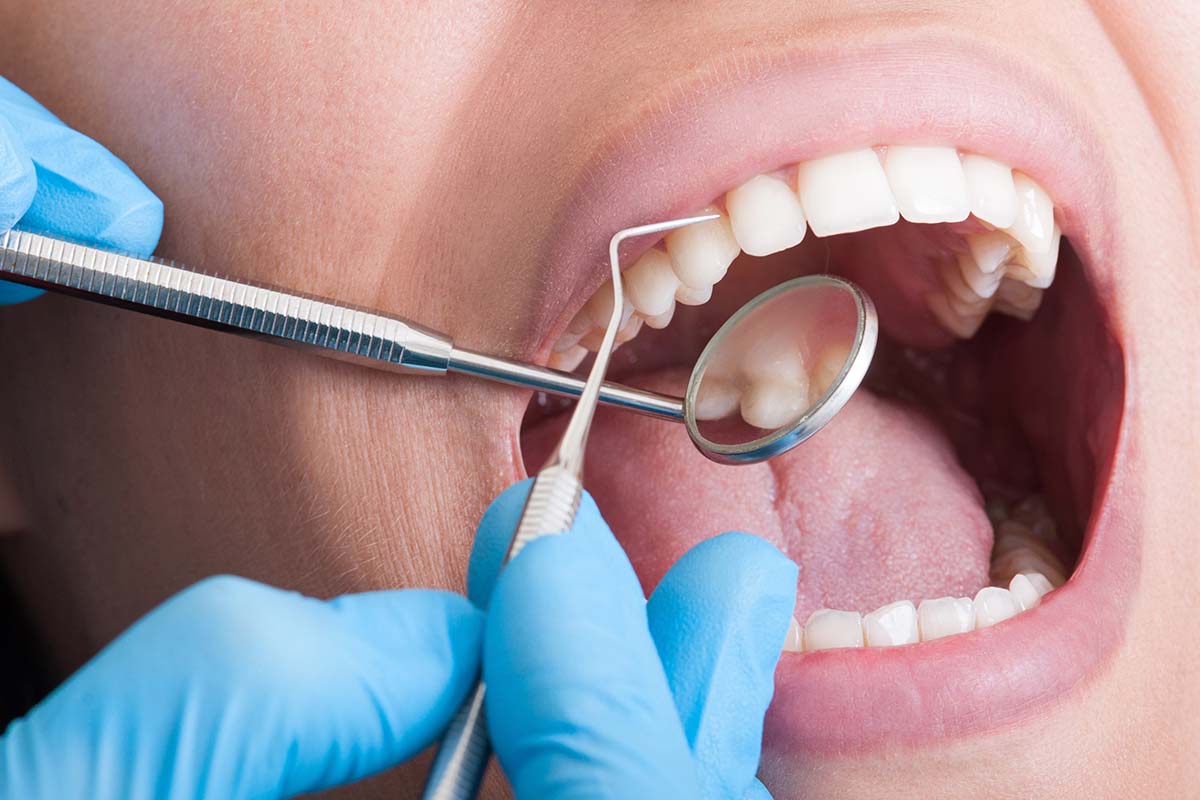 Dental Cavities: Understanding Tooth Decay and the Importance of Dental Care