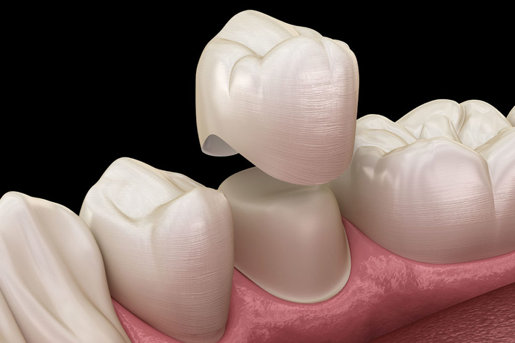 Dental Crowns The Art and Science of Restoring Smiles