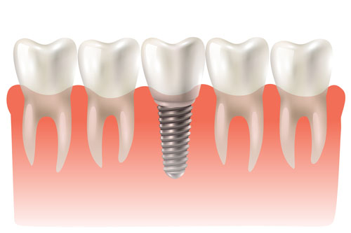 dental implant placement possition