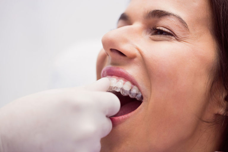 dentist assisting female patient wear clear aligner braces