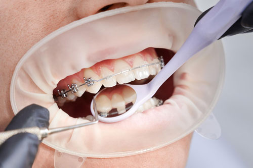 dentist attaching metal braces patient teeth