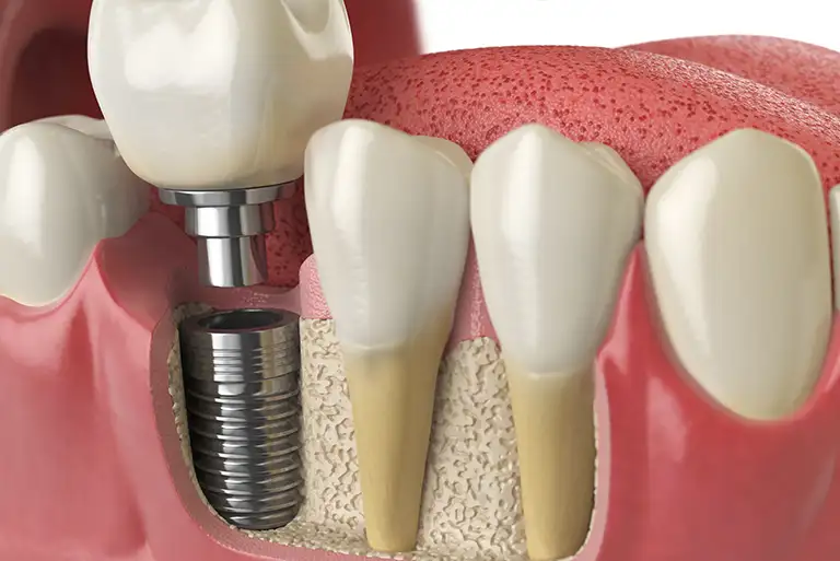 How Much Are All On Four Dental Implants