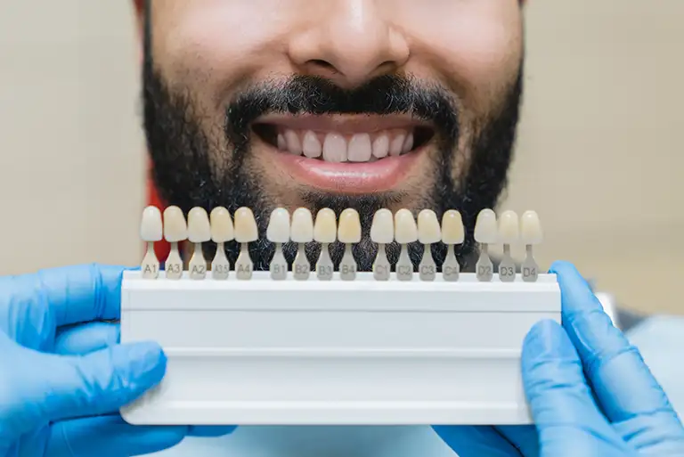 How Much Are Dental Veneers
