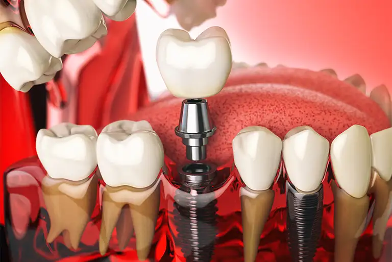 What Are All-on-4 Dental Implants