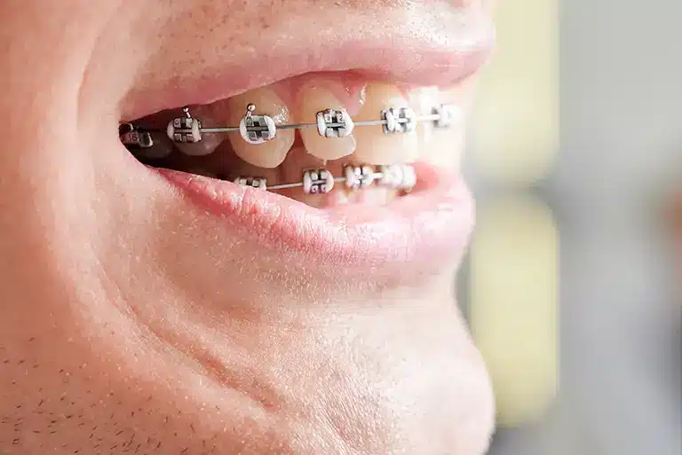 What Dental Insurance Covers Braces