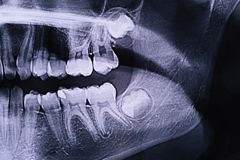 When Do Wisdom Teeth Show Up on X-Ray