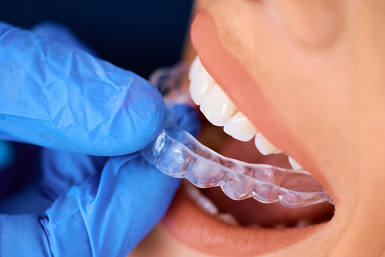 Invisalign vs Braces: Key Differences to Help You Decide