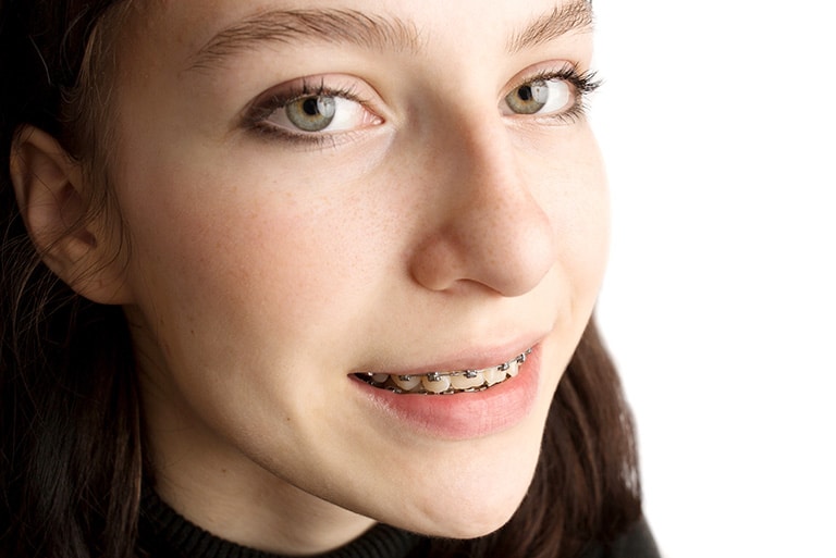 Understanding Braces Cost: Factors That Influence Orthodontic Treatment