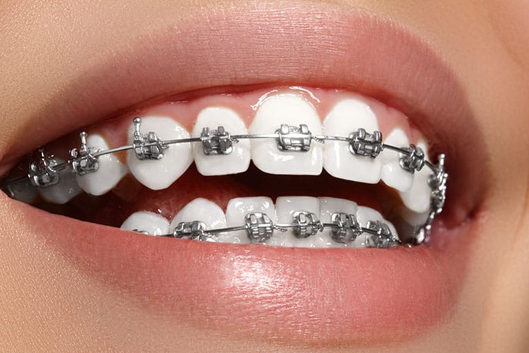 What Are Teeth Braces? Everything You Need to Know