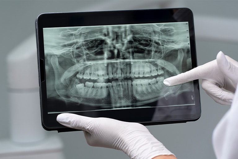 How Wisdom Teeth X-Rays Help Detect Problems Early