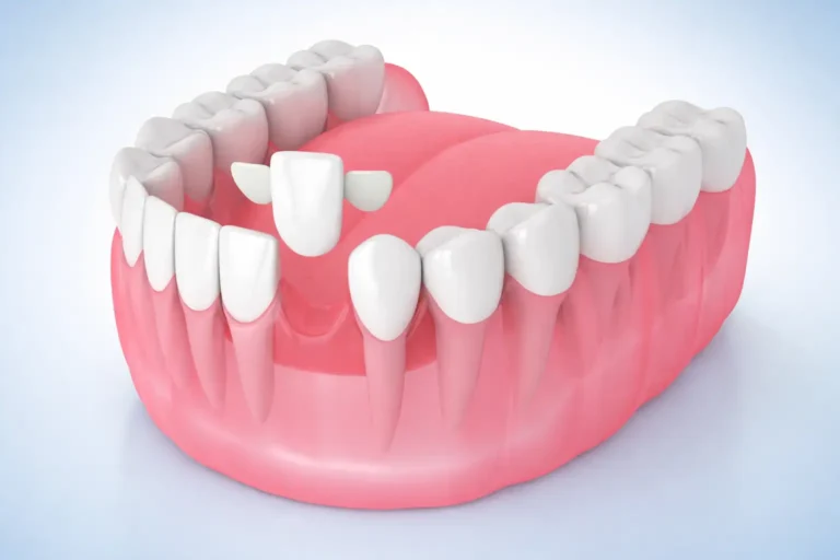 bonded dental bridges