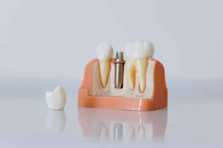 implant supported dentures