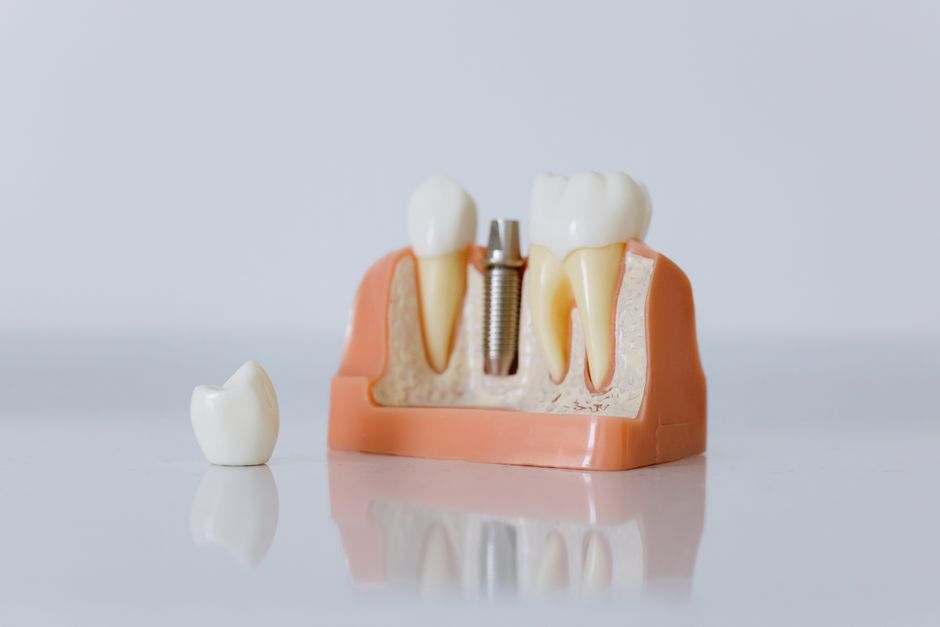 implant supported dentures