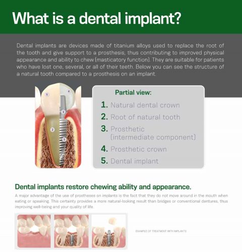 What-is-a-Dental-Implant-Poster_for-website_HR