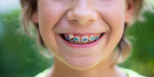 Closeup view of a child with dental braces smiling.