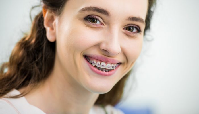 close up of happy woman with braces on teeth smiling in dental clinic