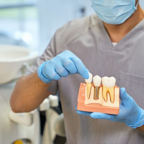Fragment photo of a medical worker in mask and gloves demonstrating how dental implants work